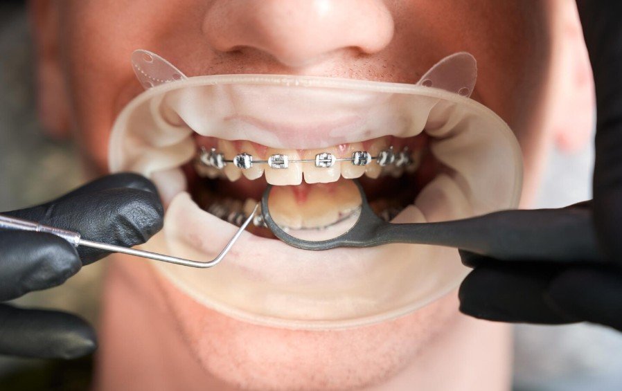 Bracket Placement and Occlusal Interference