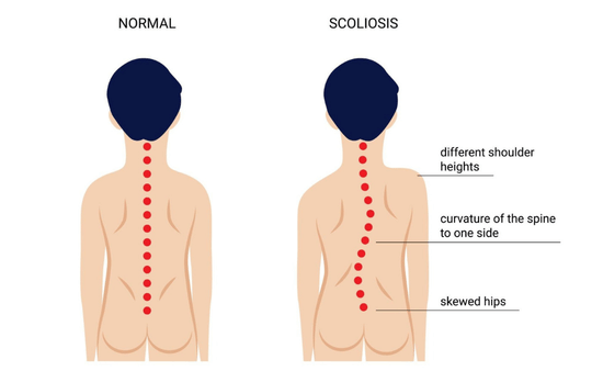How Does Scoliosis Change Over Time