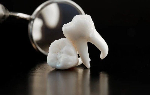 Why Wisdom Teeth Evolved and When Modern Dentistry Recommends Their Removal